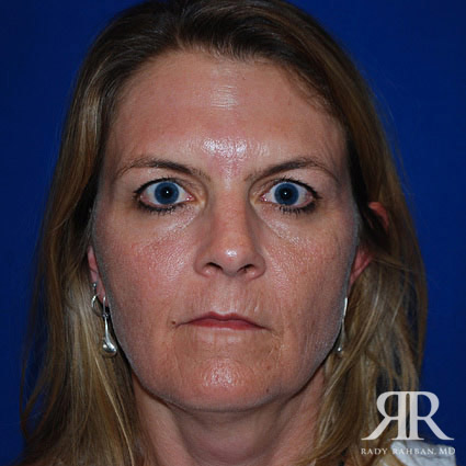 Facelift