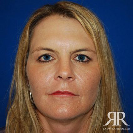Facelift results on patient