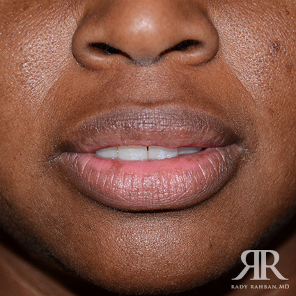 Lip reduction on patient