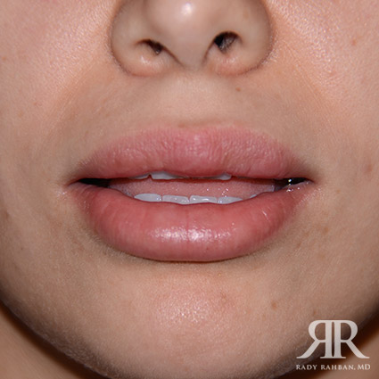 Lip Reduction / Lip Correction