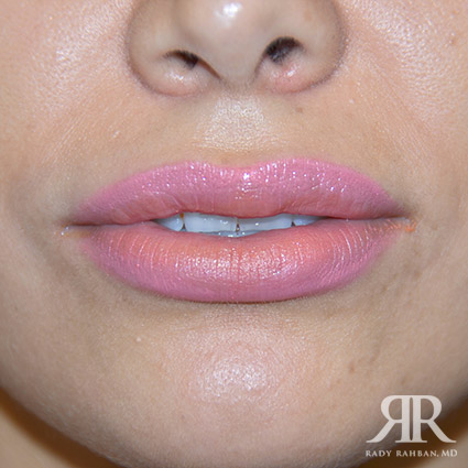 Lip reduction on patient