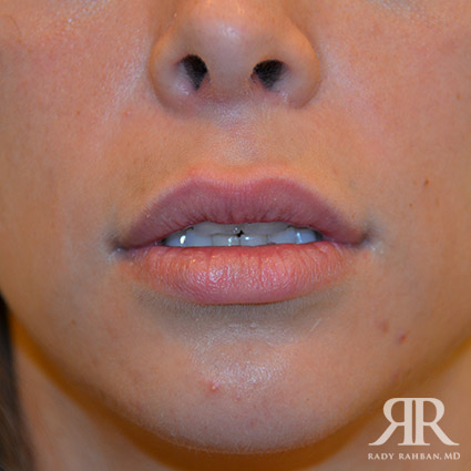 Lip reduction on patient