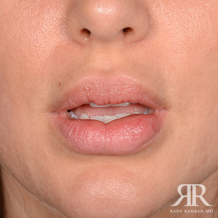 Lip Reduction / Lip Correction