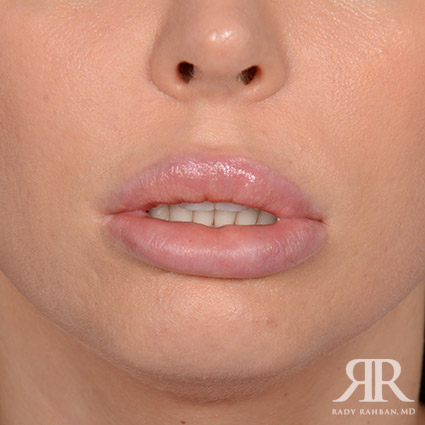 Lip Reduction / Lip Correction