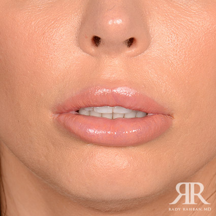 Lip Reduction / Lip Correction