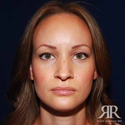 Before photo of Rhinoplasty