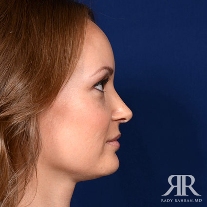 Ethnic Rhinoplasty