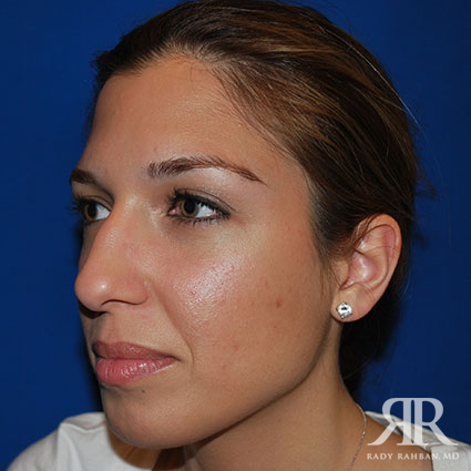 Ethnic Rhinoplasty