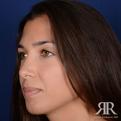 Ethnic Rhinoplasty