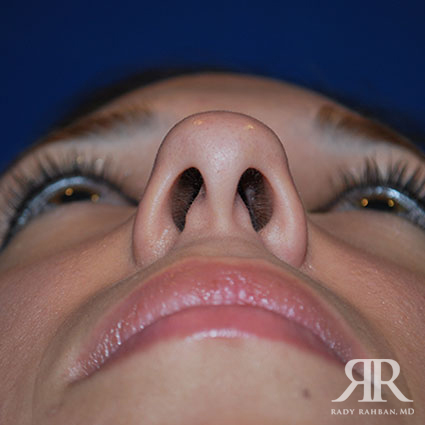 Ethnic Rhinoplasty