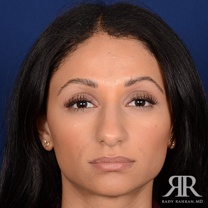 Ethnic Rhinoplasty