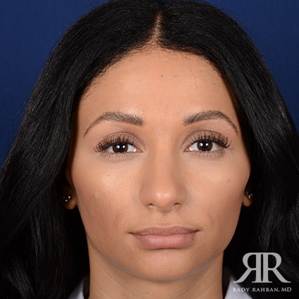 Ethnic Rhinoplasty