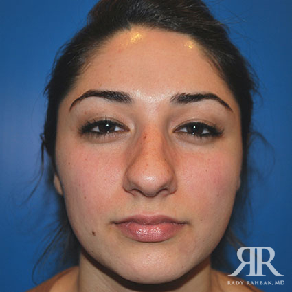 Ethnic Rhinoplasty