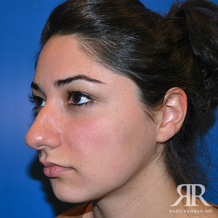 Ethnic Rhinoplasty