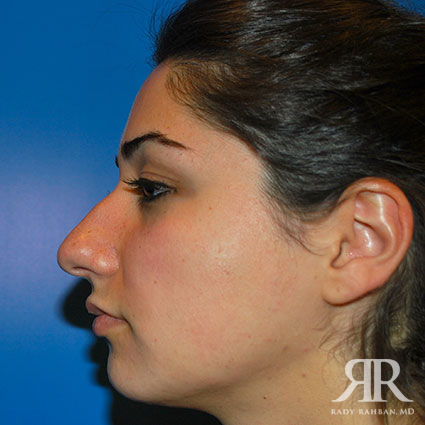 Ethnic Rhinoplasty