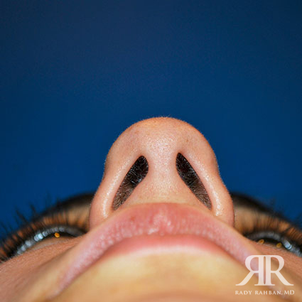 Ethnic Rhinoplasty