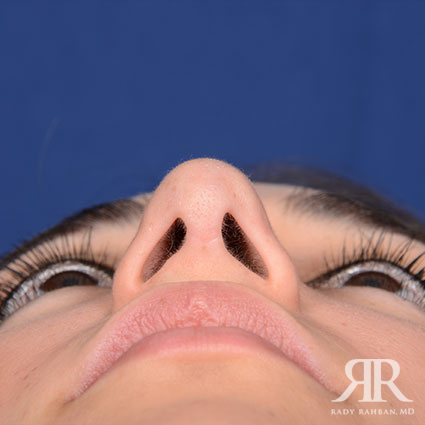 Ethnic Rhinoplasty