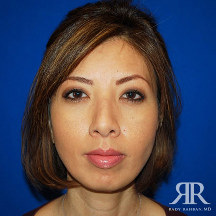 Ethnic Rhinoplasty