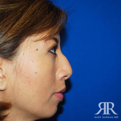 Ethnic Rhinoplasty