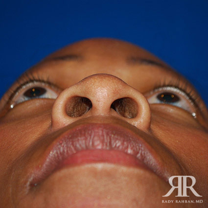 Ethnic Rhinoplasty