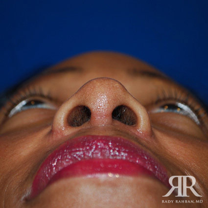 Ethnic Rhinoplasty