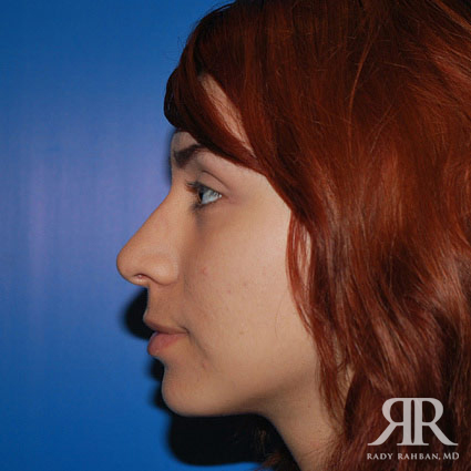 Ethnic Rhinoplasty