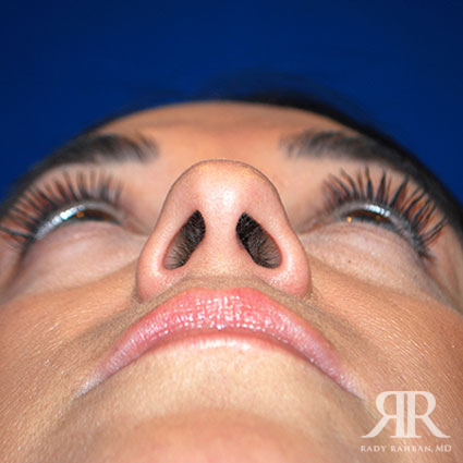 Ethnic Rhinoplasty