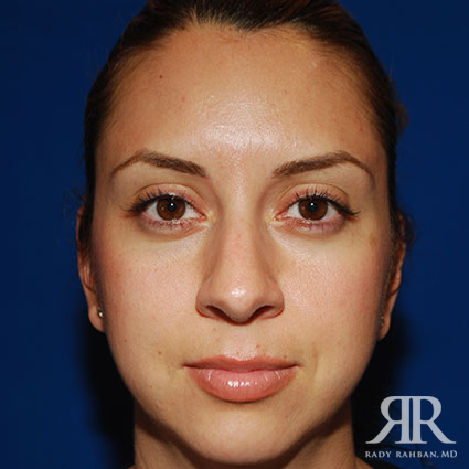 Ethnic Rhinoplasty