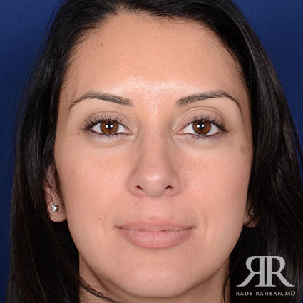 Ethnic Rhinoplasty