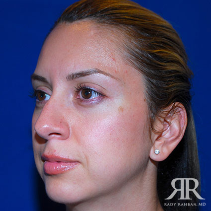 Ethnic Rhinoplasty