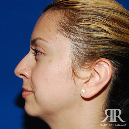 Ethnic Rhinoplasty