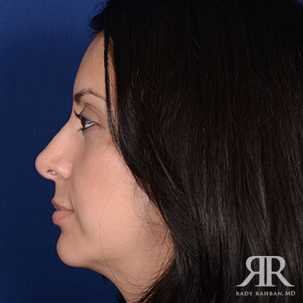 Ethnic Rhinoplasty