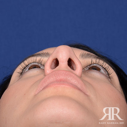 Ethnic Rhinoplasty