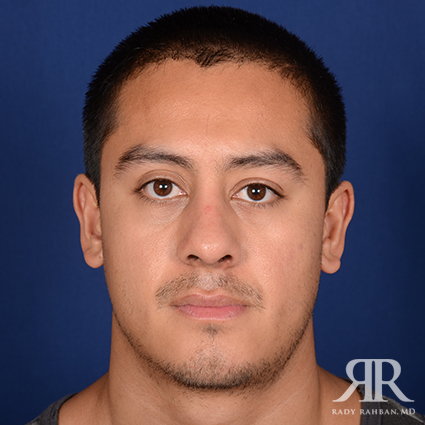 Ethnic Rhinoplasty