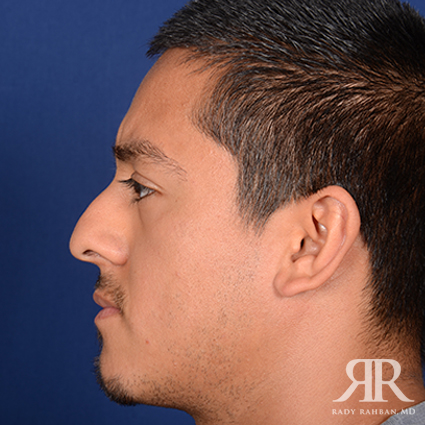 Ethnic Rhinoplasty