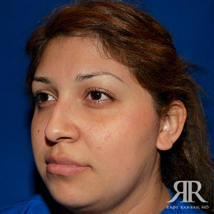 Ethnic Rhinoplasty