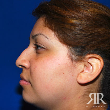 Ethnic Rhinoplasty