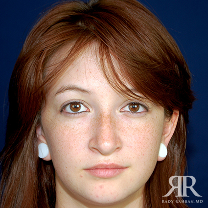 Ethnic Rhinoplasty