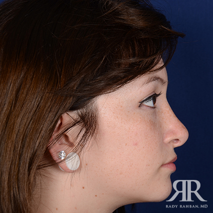 Ethnic Rhinoplasty