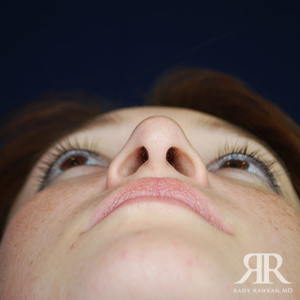 Ethnic Rhinoplasty