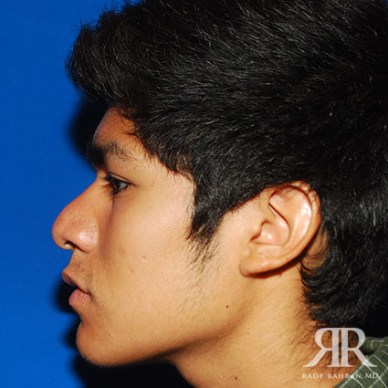 Ethnic Rhinoplasty