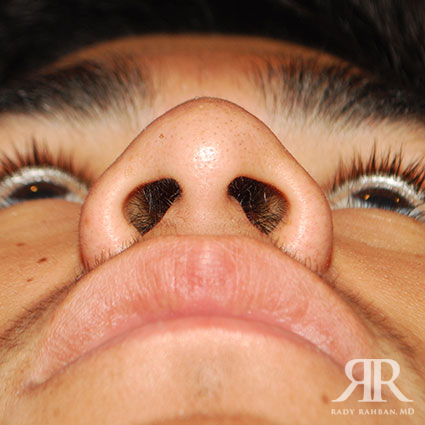 Ethnic Rhinoplasty