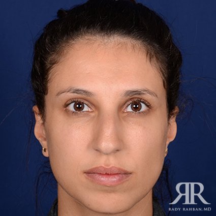 Ethnic Rhinoplasty