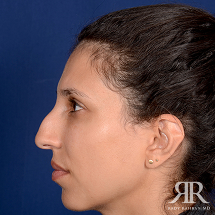 Ethnic Rhinoplasty