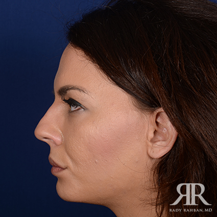 Ethnic Rhinoplasty