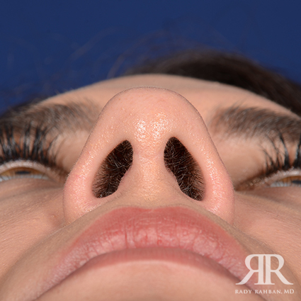 Ethnic Rhinoplasty