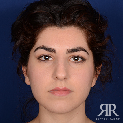 Ethnic Rhinoplasty