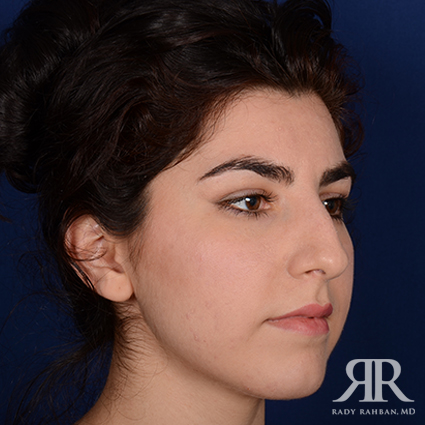 Ethnic Rhinoplasty