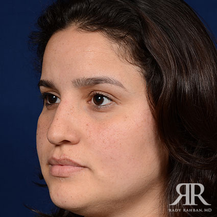 Ethnic Rhinoplasty