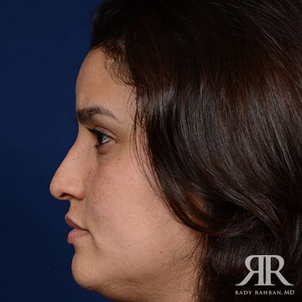 Ethnic Rhinoplasty